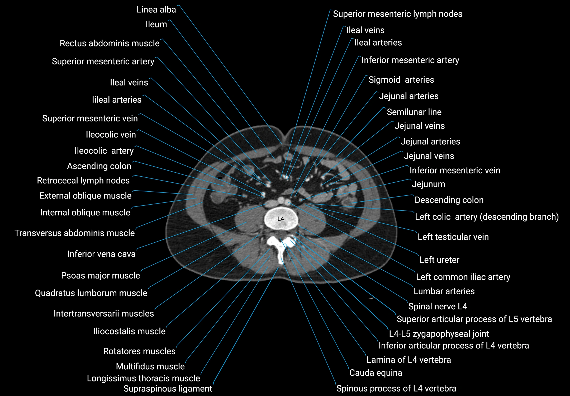 CT male pelvis axial cross sectional anatomy labelled radiology image -00113.webp